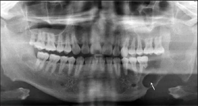 下頜骨腓骨移植聯(lián)合牙種植術(shù)后的覆蓋義齒修復(fù)1例 下頜骨腓骨移植聯(lián)合牙種植術(shù)后的覆蓋義齒修復(fù)1例