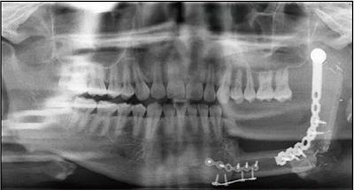 下頜骨腓骨移植聯(lián)合牙種植術(shù)后的覆蓋義齒修復(fù)1例 下頜骨腓骨移植聯(lián)合牙種植術(shù)后的覆蓋義齒修復(fù)1例