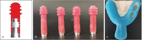 下頜骨腓骨移植聯(lián)合牙種植術(shù)后的覆蓋義齒修復(fù)1例 下頜骨腓骨移植聯(lián)合牙種植術(shù)后的覆蓋義齒修復(fù)1例