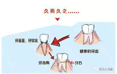 牙周炎，中國成年人后半生永遠的 痛 ！