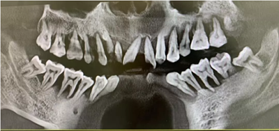 牙周炎，中國成年人后半生永遠的 痛 ！