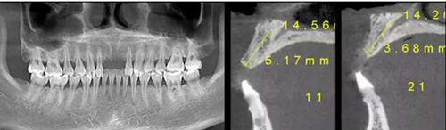 Asc全瓷角度基臺(tái)一體冠進(jìn)行種植前牙美學(xué)修復(fù)一例 Asc全瓷角度基臺(tái)一體冠進(jìn)行種植前牙美學(xué)修復(fù)一例