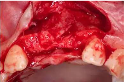 Asc全瓷角度基臺(tái)一體冠進(jìn)行種植前牙美學(xué)修復(fù)一例 Asc全瓷角度基臺(tái)一體冠進(jìn)行種植前牙美學(xué)修復(fù)一例