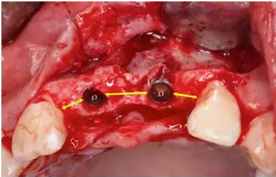 Asc全瓷角度基臺(tái)一體冠進(jìn)行種植前牙美學(xué)修復(fù)一例 Asc全瓷角度基臺(tái)一體冠進(jìn)行種植前牙美學(xué)修復(fù)一例