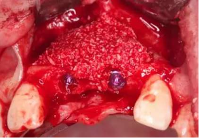 Asc全瓷角度基臺(tái)一體冠進(jìn)行種植前牙美學(xué)修復(fù)一例 Asc全瓷角度基臺(tái)一體冠進(jìn)行種植前牙美學(xué)修復(fù)一例