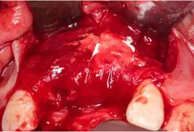 Asc全瓷角度基臺(tái)一體冠進(jìn)行種植前牙美學(xué)修復(fù)一例 Asc全瓷角度基臺(tái)一體冠進(jìn)行種植前牙美學(xué)修復(fù)一例