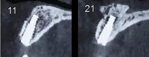 Asc全瓷角度基臺(tái)一體冠進(jìn)行種植前牙美學(xué)修復(fù)一例 Asc全瓷角度基臺(tái)一體冠進(jìn)行種植前牙美學(xué)修復(fù)一例