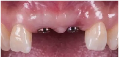 Asc全瓷角度基臺(tái)一體冠進(jìn)行種植前牙美學(xué)修復(fù)一例 Asc全瓷角度基臺(tái)一體冠進(jìn)行種植前牙美學(xué)修復(fù)一例