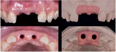 Asc全瓷角度基臺(tái)一體冠進(jìn)行種植前牙美學(xué)修復(fù)一例 Asc全瓷角度基臺(tái)一體冠進(jìn)行種植前牙美學(xué)修復(fù)一例