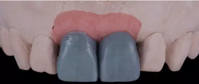 Asc全瓷角度基臺(tái)一體冠進(jìn)行種植前牙美學(xué)修復(fù)一例 Asc全瓷角度基臺(tái)一體冠進(jìn)行種植前牙美學(xué)修復(fù)一例