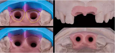 Asc全瓷角度基臺(tái)一體冠進(jìn)行種植前牙美學(xué)修復(fù)一例 Asc全瓷角度基臺(tái)一體冠進(jìn)行種植前牙美學(xué)修復(fù)一例