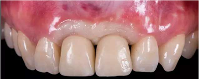 Asc全瓷角度基臺(tái)一體冠進(jìn)行種植前牙美學(xué)修復(fù)一例 Asc全瓷角度基臺(tái)一體冠進(jìn)行種植前牙美學(xué)修復(fù)一例