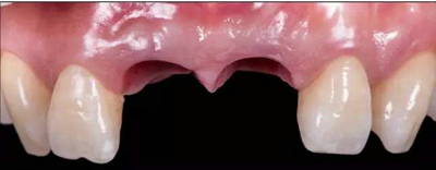 Asc全瓷角度基臺(tái)一體冠進(jìn)行種植前牙美學(xué)修復(fù)一例 Asc全瓷角度基臺(tái)一體冠進(jìn)行種植前牙美學(xué)修復(fù)一例