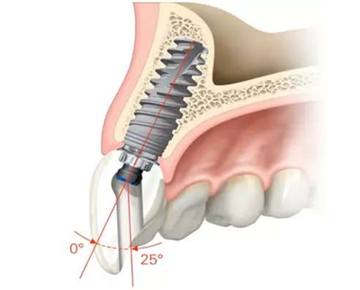 Asc全瓷角度基臺(tái)一體冠進(jìn)行種植前牙美學(xué)修復(fù)一例 Asc全瓷角度基臺(tái)一體冠進(jìn)行種植前牙美學(xué)修復(fù)一例