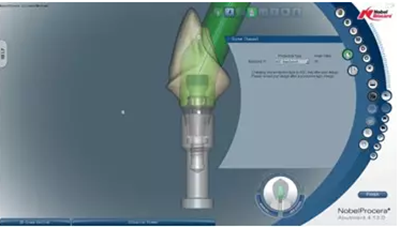 Asc全瓷角度基臺(tái)一體冠進(jìn)行種植前牙美學(xué)修復(fù)一例 Asc全瓷角度基臺(tái)一體冠進(jìn)行種植前牙美學(xué)修復(fù)一例