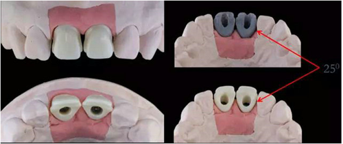 Asc全瓷角度基臺(tái)一體冠進(jìn)行種植前牙美學(xué)修復(fù)一例 Asc全瓷角度基臺(tái)一體冠進(jìn)行種植前牙美學(xué)修復(fù)一例