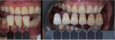 Asc全瓷角度基臺(tái)一體冠進(jìn)行種植前牙美學(xué)修復(fù)一例 Asc全瓷角度基臺(tái)一體冠進(jìn)行種植前牙美學(xué)修復(fù)一例