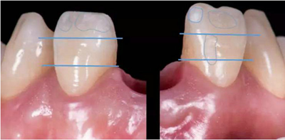 Asc全瓷角度基臺(tái)一體冠進(jìn)行種植前牙美學(xué)修復(fù)一例 Asc全瓷角度基臺(tái)一體冠進(jìn)行種植前牙美學(xué)修復(fù)一例