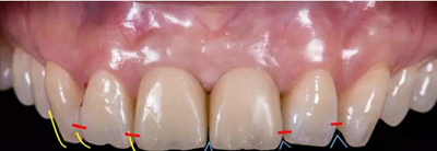 Asc全瓷角度基臺(tái)一體冠進(jìn)行種植前牙美學(xué)修復(fù)一例 Asc全瓷角度基臺(tái)一體冠進(jìn)行種植前牙美學(xué)修復(fù)一例