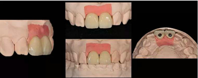 Asc全瓷角度基臺(tái)一體冠進(jìn)行種植前牙美學(xué)修復(fù)一例 Asc全瓷角度基臺(tái)一體冠進(jìn)行種植前牙美學(xué)修復(fù)一例