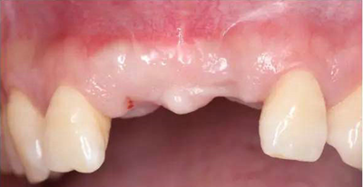 Asc全瓷角度基臺(tái)一體冠進(jìn)行種植前牙美學(xué)修復(fù)一例 Asc全瓷角度基臺(tái)一體冠進(jìn)行種植前牙美學(xué)修復(fù)一例