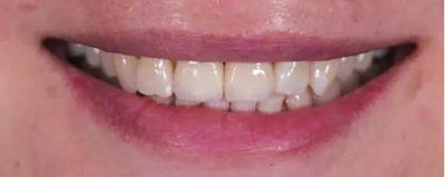 Asc全瓷角度基臺(tái)一體冠進(jìn)行種植前牙美學(xué)修復(fù)一例 Asc全瓷角度基臺(tái)一體冠進(jìn)行種植前牙美學(xué)修復(fù)一例