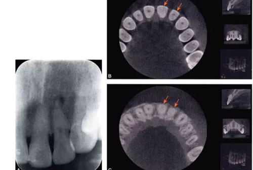 (六期)細(xì)小鈣化根管的疏通——病因及診斷 (六期)細(xì)小鈣化根管的疏通——病因及診斷