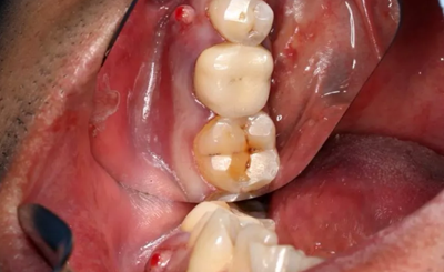 病例分享|下頜后牙牙槽嵴保存延期種植頰側(cè)骨壁吸收植骨引導(dǎo)骨再生一例 病例分享|下頜后牙牙槽嵴保存延期種植頰側(cè)骨壁吸收植骨引導(dǎo)骨再生一例