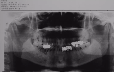 病例分享|下頜后牙牙槽嵴保存延期種植頰側(cè)骨壁吸收植骨引導(dǎo)骨再生一例 病例分享|下頜后牙牙槽嵴保存延期種植頰側(cè)骨壁吸收植骨引導(dǎo)骨再生一例