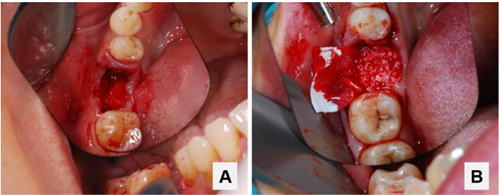 病例分享|下頜后牙牙槽嵴保存延期種植頰側(cè)骨壁吸收植骨引導(dǎo)骨再生一例 病例分享|下頜后牙牙槽嵴保存延期種植頰側(cè)骨壁吸收植骨引導(dǎo)骨再生一例
