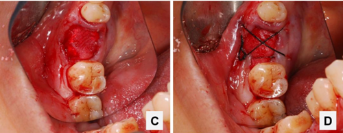 病例分享|下頜后牙牙槽嵴保存延期種植頰側(cè)骨壁吸收植骨引導(dǎo)骨再生一例 病例分享|下頜后牙牙槽嵴保存延期種植頰側(cè)骨壁吸收植骨引導(dǎo)骨再生一例