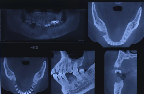 病例分享|下頜后牙牙槽嵴保存延期種植頰側(cè)骨壁吸收植骨引導(dǎo)骨再生一例 病例分享|下頜后牙牙槽嵴保存延期種植頰側(cè)骨壁吸收植骨引導(dǎo)骨再生一例