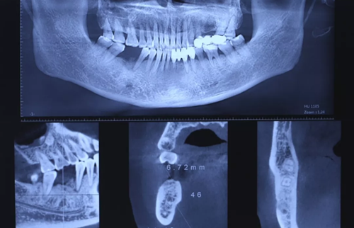 病例分享|下頜后牙牙槽嵴保存延期種植頰側(cè)骨壁吸收植骨引導(dǎo)骨再生一例 病例分享|下頜后牙牙槽嵴保存延期種植頰側(cè)骨壁吸收植骨引導(dǎo)骨再生一例