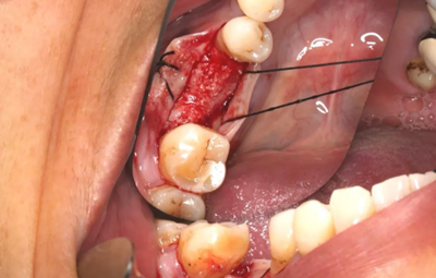 病例分享|下頜后牙牙槽嵴保存延期種植頰側(cè)骨壁吸收植骨引導(dǎo)骨再生一例 病例分享|下頜后牙牙槽嵴保存延期種植頰側(cè)骨壁吸收植骨引導(dǎo)骨再生一例