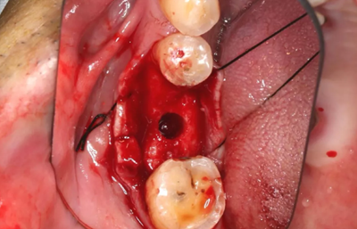 病例分享|下頜后牙牙槽嵴保存延期種植頰側(cè)骨壁吸收植骨引導(dǎo)骨再生一例 病例分享|下頜后牙牙槽嵴保存延期種植頰側(cè)骨壁吸收植骨引導(dǎo)骨再生一例