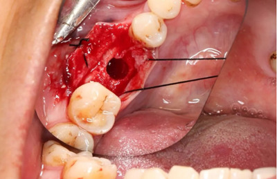 病例分享|下頜后牙牙槽嵴保存延期種植頰側(cè)骨壁吸收植骨引導(dǎo)骨再生一例 病例分享|下頜后牙牙槽嵴保存延期種植頰側(cè)骨壁吸收植骨引導(dǎo)骨再生一例