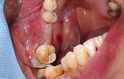 病例分享|下頜后牙牙槽嵴保存延期種植頰側(cè)骨壁吸收植骨引導(dǎo)骨再生一例 病例分享|下頜后牙牙槽嵴保存延期種植頰側(cè)骨壁吸收植骨引導(dǎo)骨再生一例