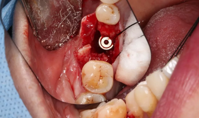 病例分享|下頜后牙牙槽嵴保存延期種植頰側(cè)骨壁吸收植骨引導(dǎo)骨再生一例 病例分享|下頜后牙牙槽嵴保存延期種植頰側(cè)骨壁吸收植骨引導(dǎo)骨再生一例
