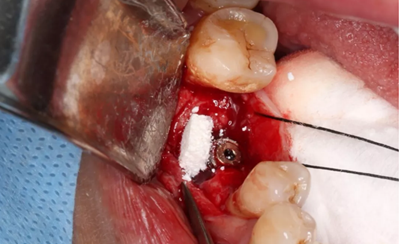 病例分享|下頜后牙牙槽嵴保存延期種植頰側(cè)骨壁吸收植骨引導(dǎo)骨再生一例 病例分享|下頜后牙牙槽嵴保存延期種植頰側(cè)骨壁吸收植骨引導(dǎo)骨再生一例