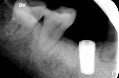 病例分享|下頜后牙牙槽嵴保存延期種植頰側(cè)骨壁吸收植骨引導(dǎo)骨再生一例 病例分享|下頜后牙牙槽嵴保存延期種植頰側(cè)骨壁吸收植骨引導(dǎo)骨再生一例