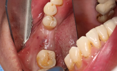 病例分享|下頜后牙牙槽嵴保存延期種植頰側(cè)骨壁吸收植骨引導(dǎo)骨再生一例 病例分享|下頜后牙牙槽嵴保存延期種植頰側(cè)骨壁吸收植骨引導(dǎo)骨再生一例