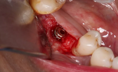 病例分享|下頜后牙牙槽嵴保存延期種植頰側(cè)骨壁吸收植骨引導(dǎo)骨再生一例 病例分享|下頜后牙牙槽嵴保存延期種植頰側(cè)骨壁吸收植骨引導(dǎo)骨再生一例