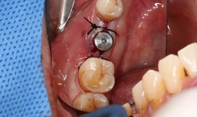 病例分享|下頜后牙牙槽嵴保存延期種植頰側(cè)骨壁吸收植骨引導(dǎo)骨再生一例 病例分享|下頜后牙牙槽嵴保存延期種植頰側(cè)骨壁吸收植骨引導(dǎo)骨再生一例