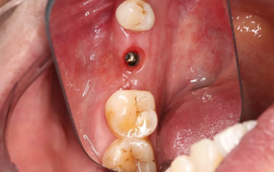 病例分享|下頜后牙牙槽嵴保存延期種植頰側(cè)骨壁吸收植骨引導(dǎo)骨再生一例 病例分享|下頜后牙牙槽嵴保存延期種植頰側(cè)骨壁吸收植骨引導(dǎo)骨再生一例