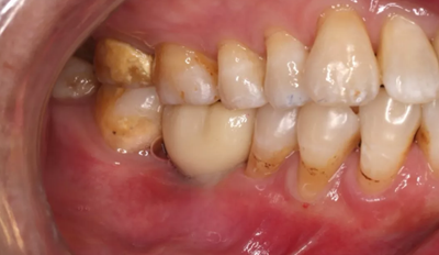 病例分享|下頜后牙牙槽嵴保存延期種植頰側(cè)骨壁吸收植骨引導(dǎo)骨再生一例 病例分享|下頜后牙牙槽嵴保存延期種植頰側(cè)骨壁吸收植骨引導(dǎo)骨再生一例