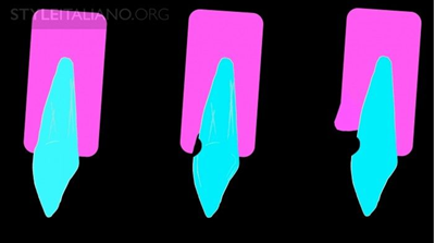 病例分享|下頜后牙牙槽嵴保存延期種植頰側骨壁吸收植骨引導骨再生一例 病例分享|下頜后牙牙槽嵴保存延期種植頰側骨壁吸收植骨引導骨再生一例