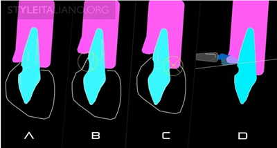 病例分享|下頜后牙牙槽嵴保存延期種植頰側骨壁吸收植骨引導骨再生一例 病例分享|下頜后牙牙槽嵴保存延期種植頰側骨壁吸收植骨引導骨再生一例