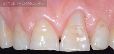 病例分享|下頜后牙牙槽嵴保存延期種植頰側骨壁吸收植骨引導骨再生一例 病例分享|下頜后牙牙槽嵴保存延期種植頰側骨壁吸收植骨引導骨再生一例