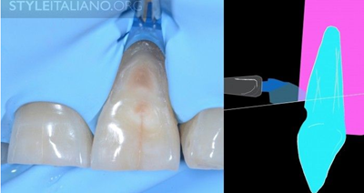 病例分享|下頜后牙牙槽嵴保存延期種植頰側骨壁吸收植骨引導骨再生一例 病例分享|下頜后牙牙槽嵴保存延期種植頰側骨壁吸收植骨引導骨再生一例