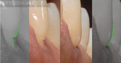 病例分享|下頜后牙牙槽嵴保存延期種植頰側骨壁吸收植骨引導骨再生一例 病例分享|下頜后牙牙槽嵴保存延期種植頰側骨壁吸收植骨引導骨再生一例